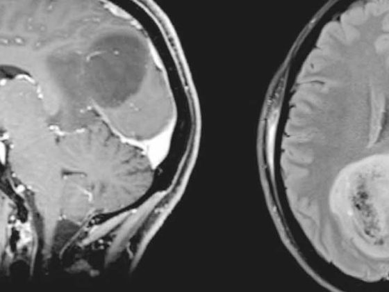 tumor