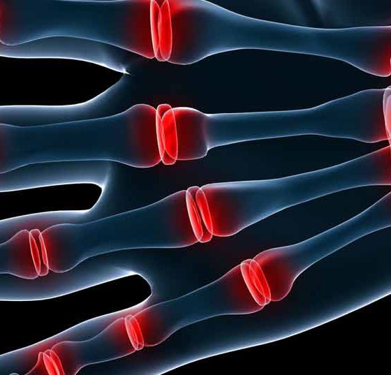 arthritis