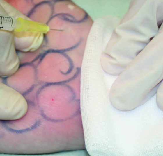 botox_hand