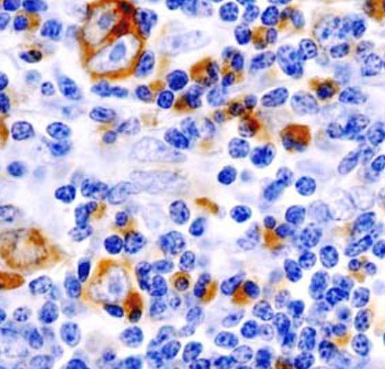 lymphom