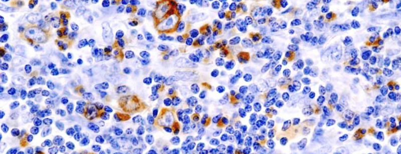 lymphom