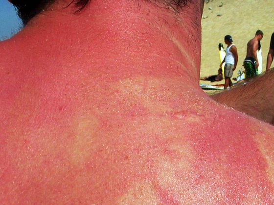 sonnenbrand