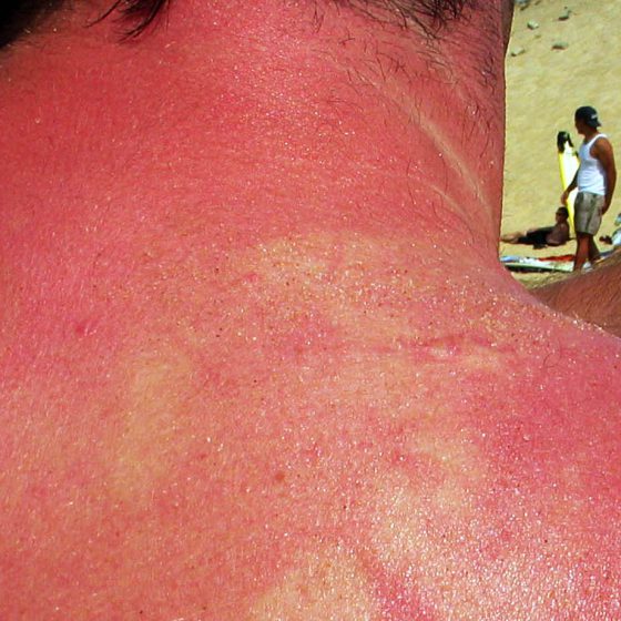 sonnenbrand