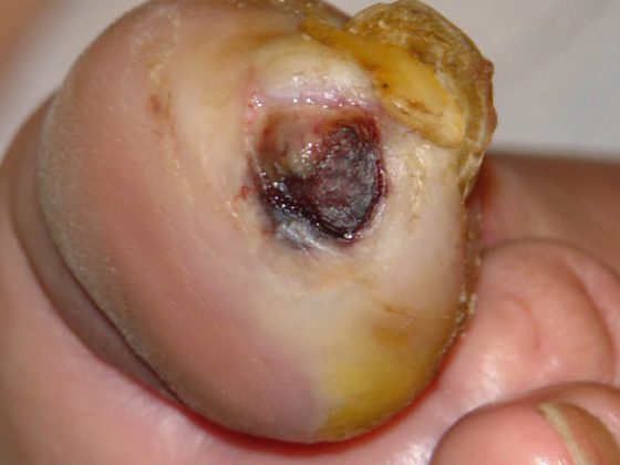 diabetes_fuss