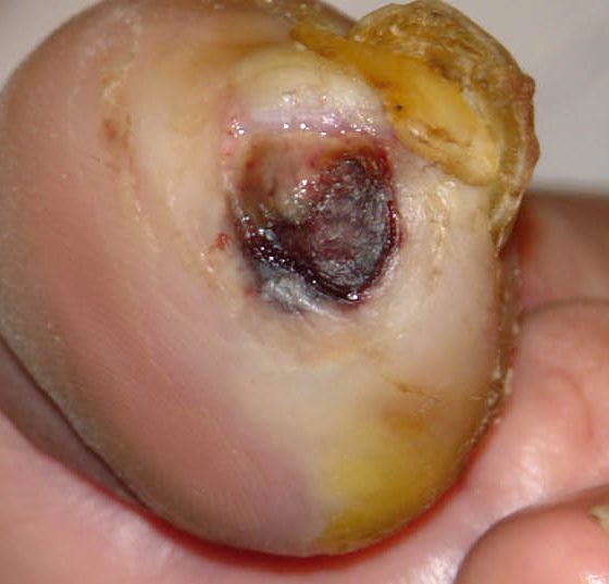 diabetes_fuss