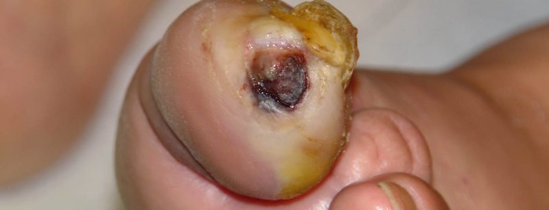 diabetes_fuss
