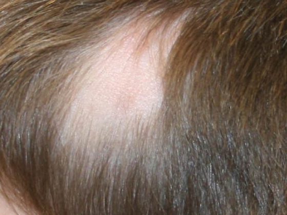 header_alopecia_dp4