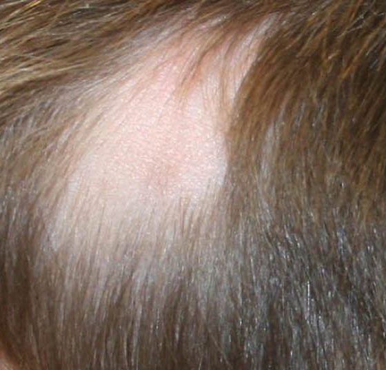 header_alopecia_dp4