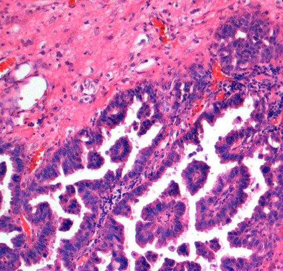 hirnmetastase