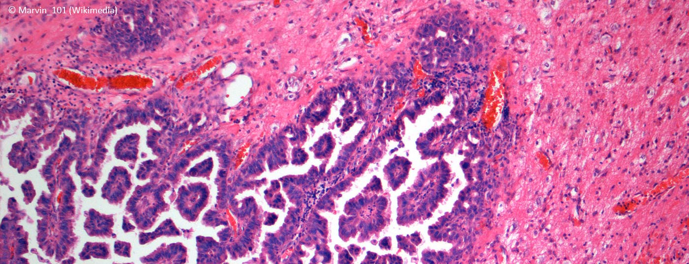 hirnmetastase