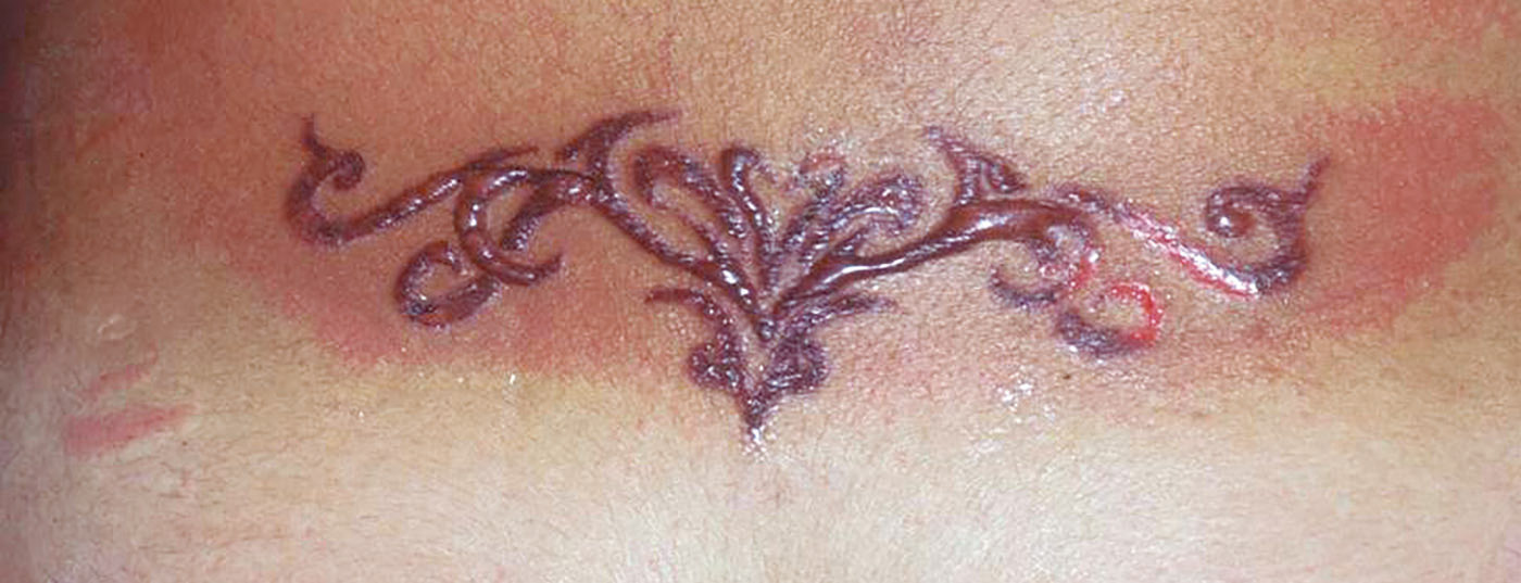 allergie_tattoo_blackhenna