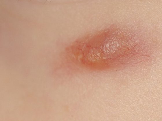 nodulus