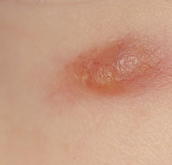 nodulus