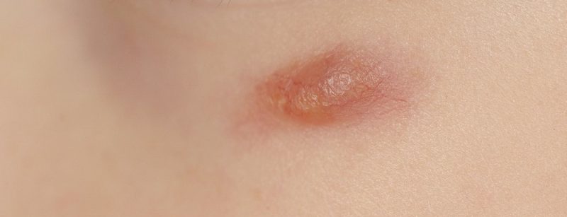 nodulus