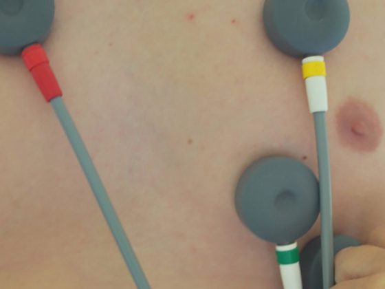 ekg_herz2
