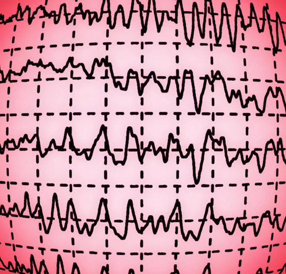 eeg_hirnwellen