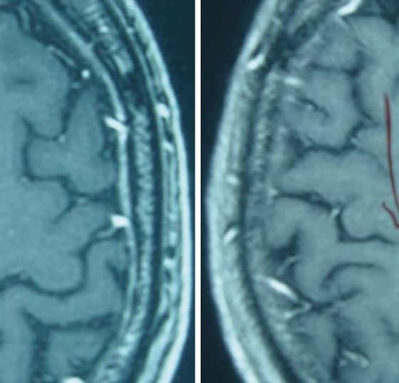 hirnmetastase_hirntumor