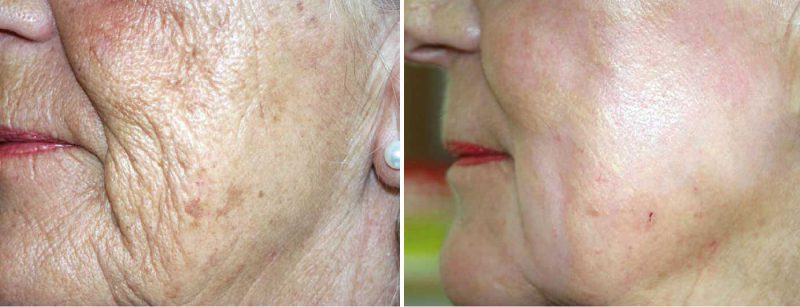 falten_peeling_kreyden