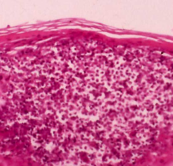 folliculitis_demodicose