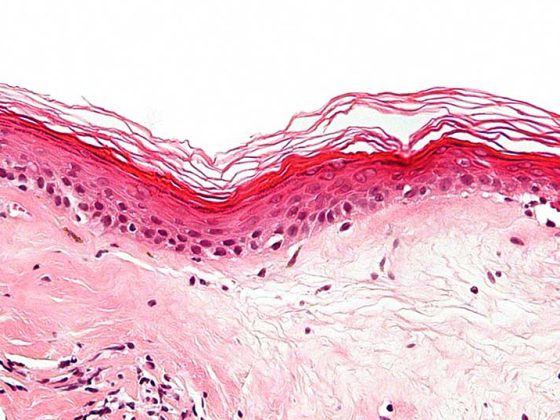 lichen_sclerosus