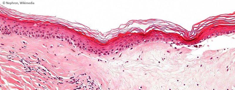 lichen_sclerosus