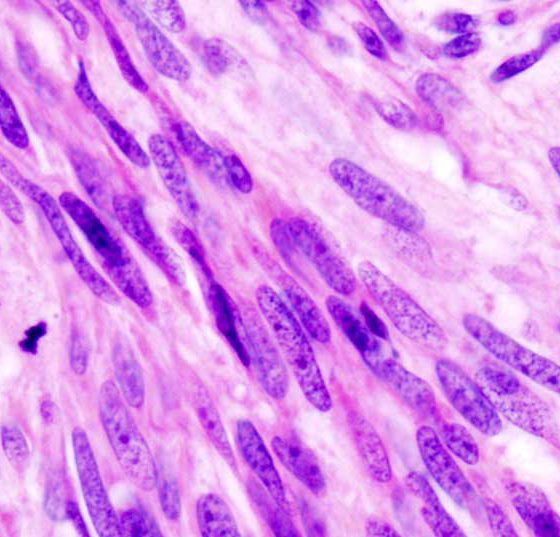 gist_gastric