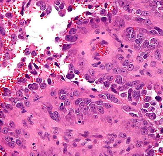 angiosarkom