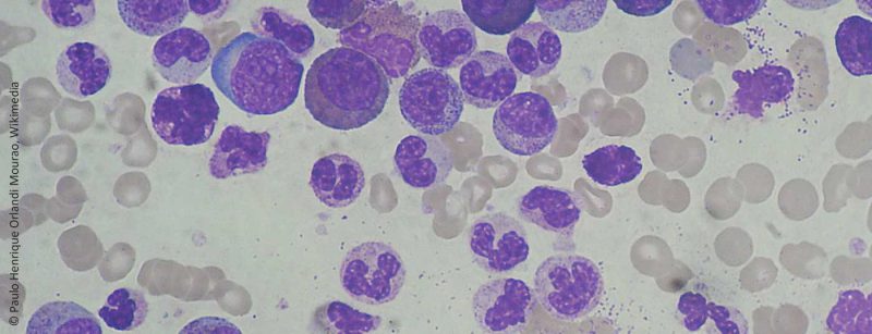 chronic_myeloid_leukemia_smear_2009-04-09