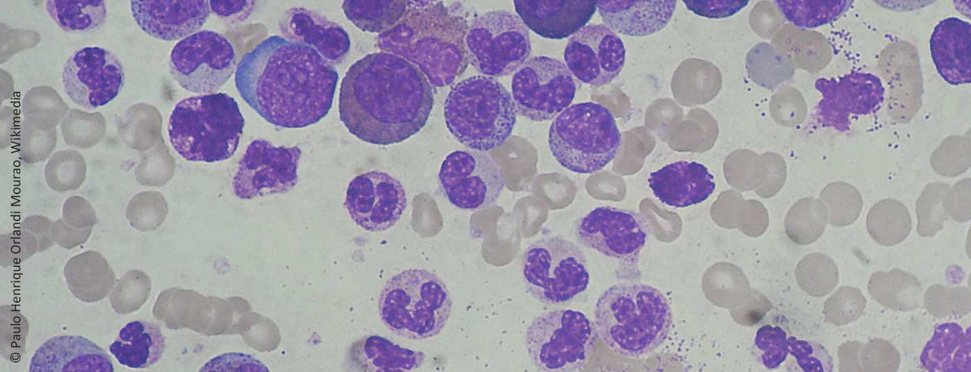 chronic_myeloid_leukemia_smear_2009-04-09
