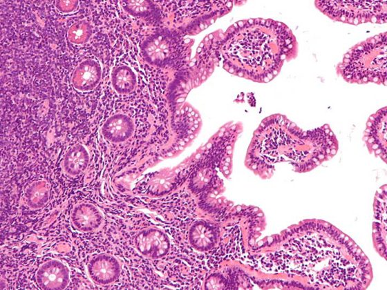 mantelzelllymphom