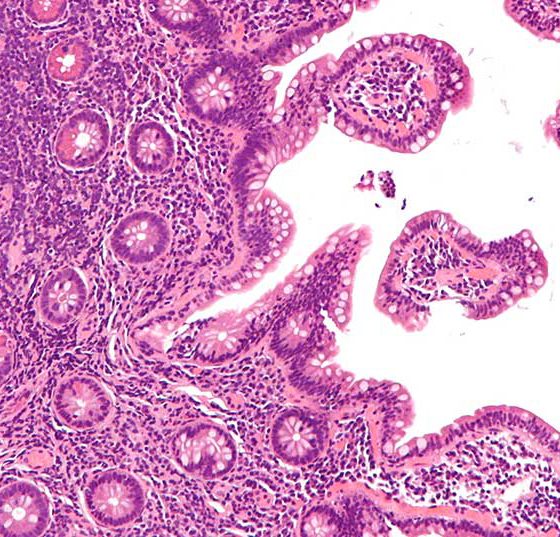 mantelzelllymphom