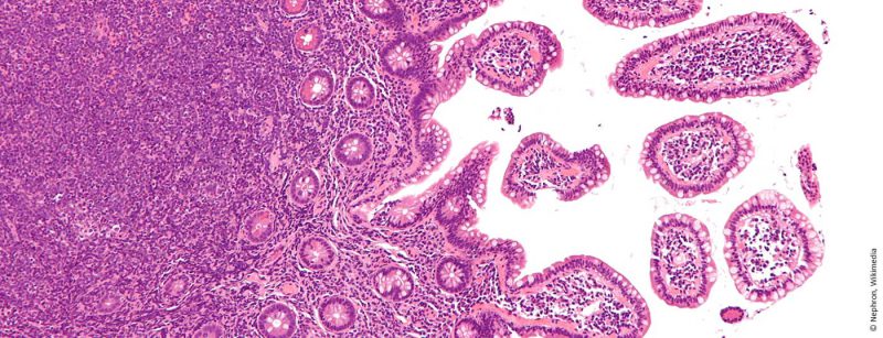 mantelzelllymphom