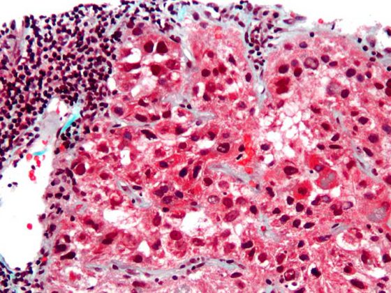 hepatocellular_carcinoma_intermed_mag