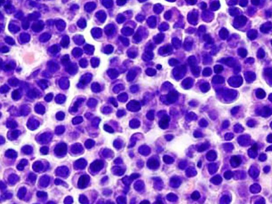 multples_myelom2