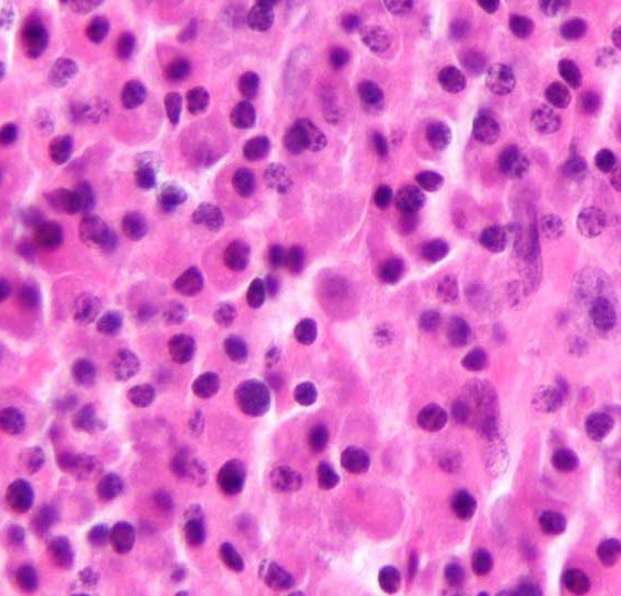 plasmacytoma1