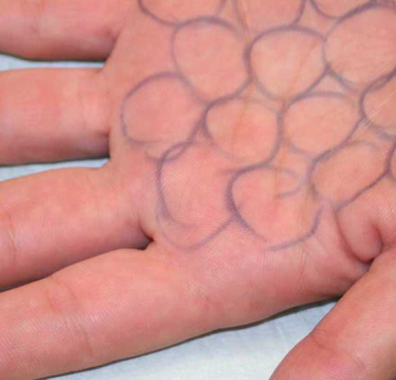botox_hand2