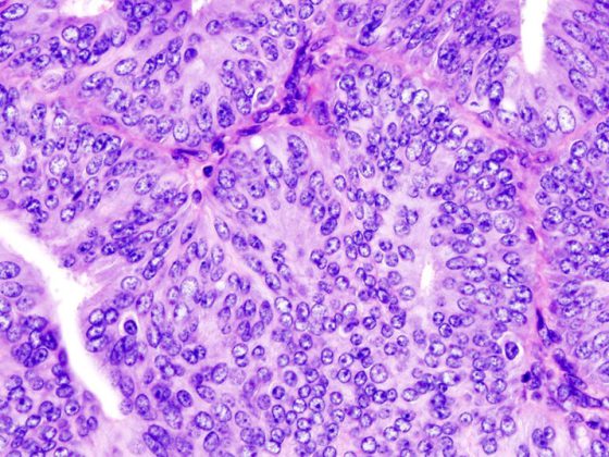 endometriumkarzinom