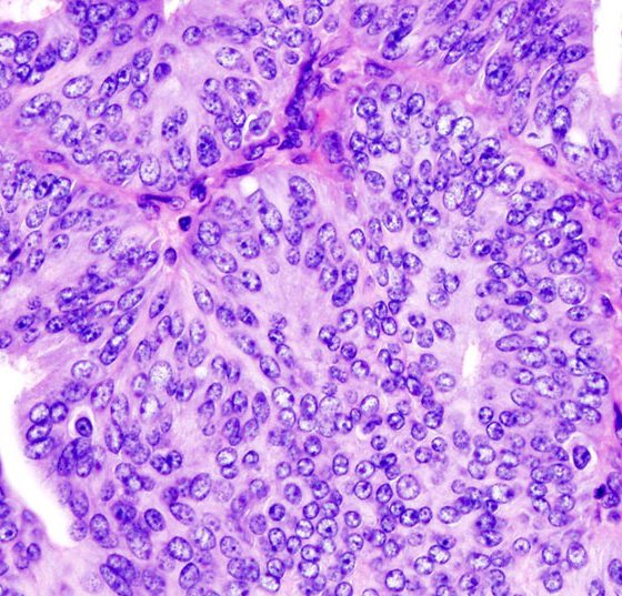 endometriumkarzinom