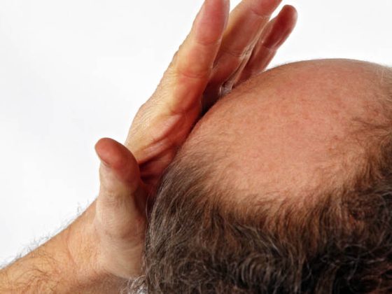 glatze_alopezie