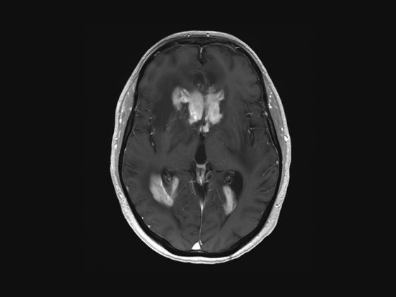 zns-lymphom