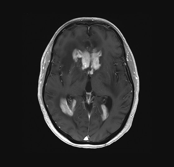 zns-lymphom