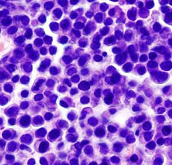 multples_myelom2