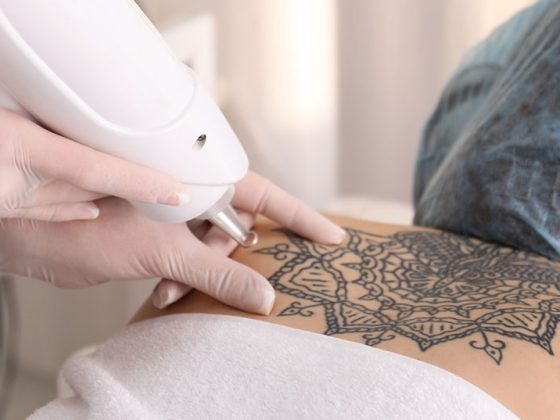 tattooentfernung