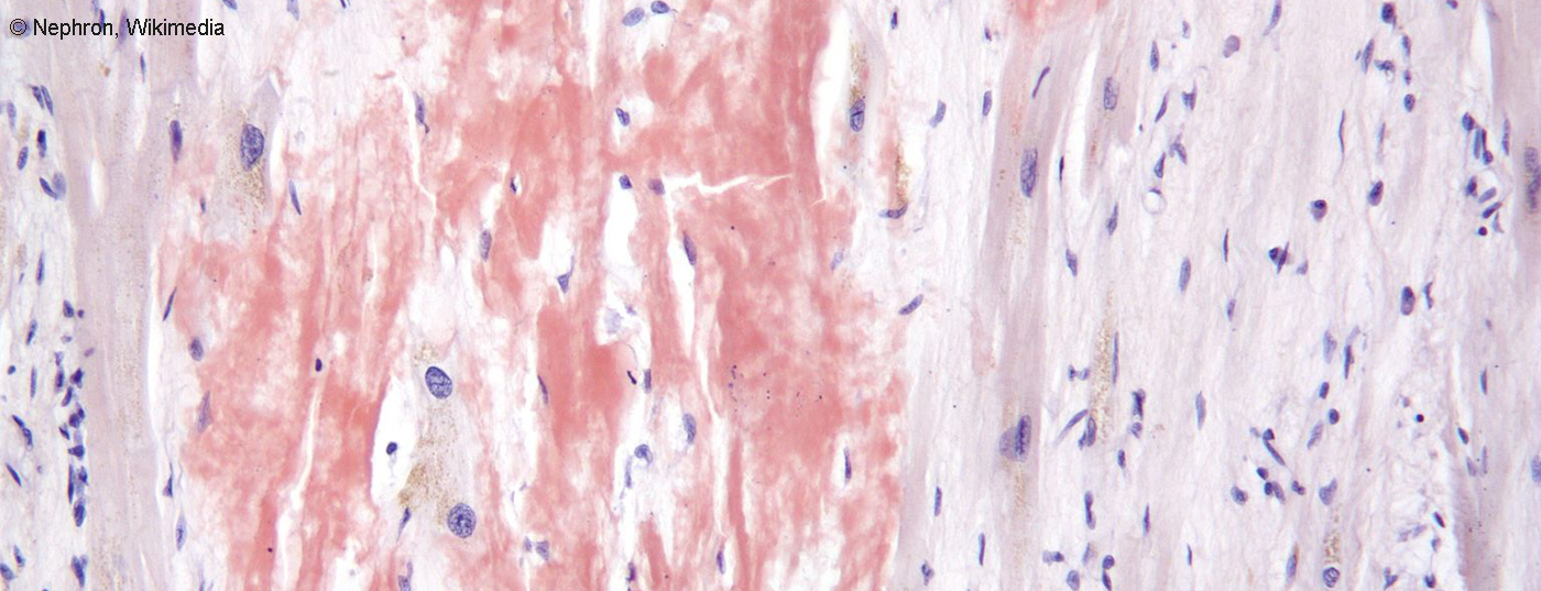 cardiac_amyloidosis_high_mag