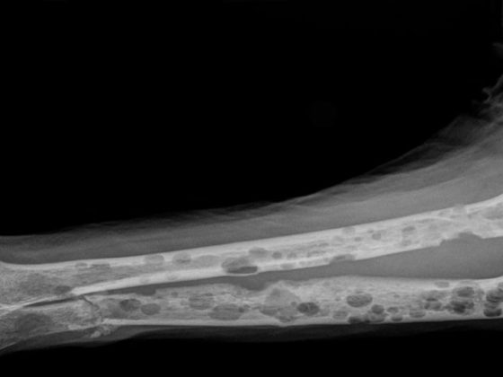 myelom