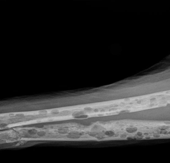 myelom