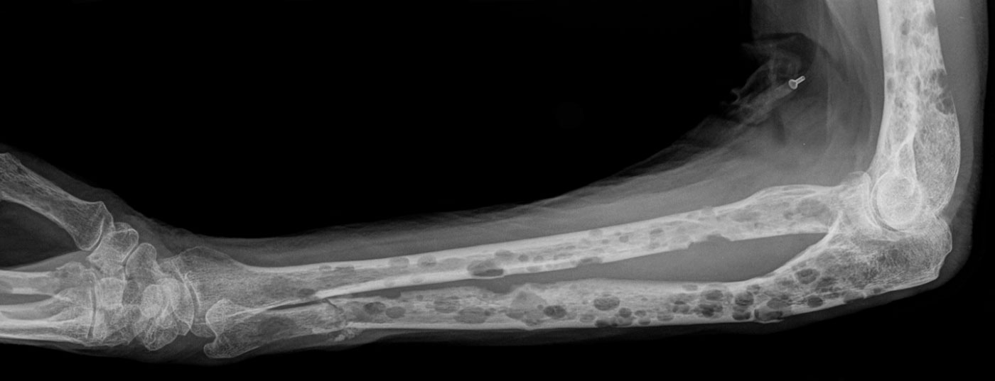 myelom