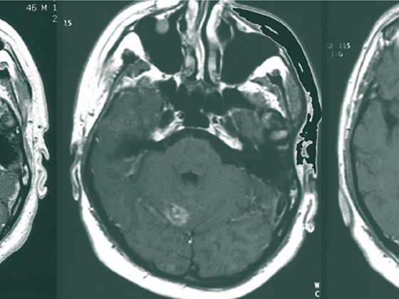 metastase_hirn