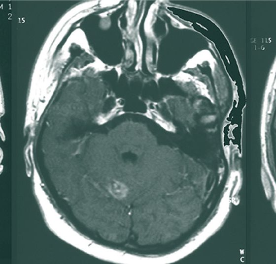 metastase_hirn