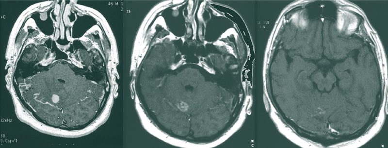 metastase_hirn